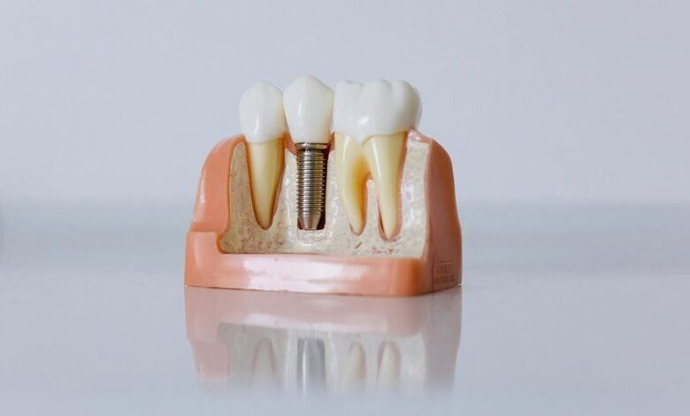 dental implants in hungary
